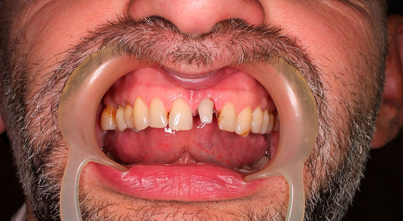 Зуб покрыт временной коронкой