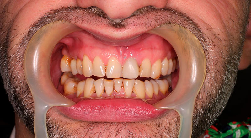 Зуб покрыт временной коронкой